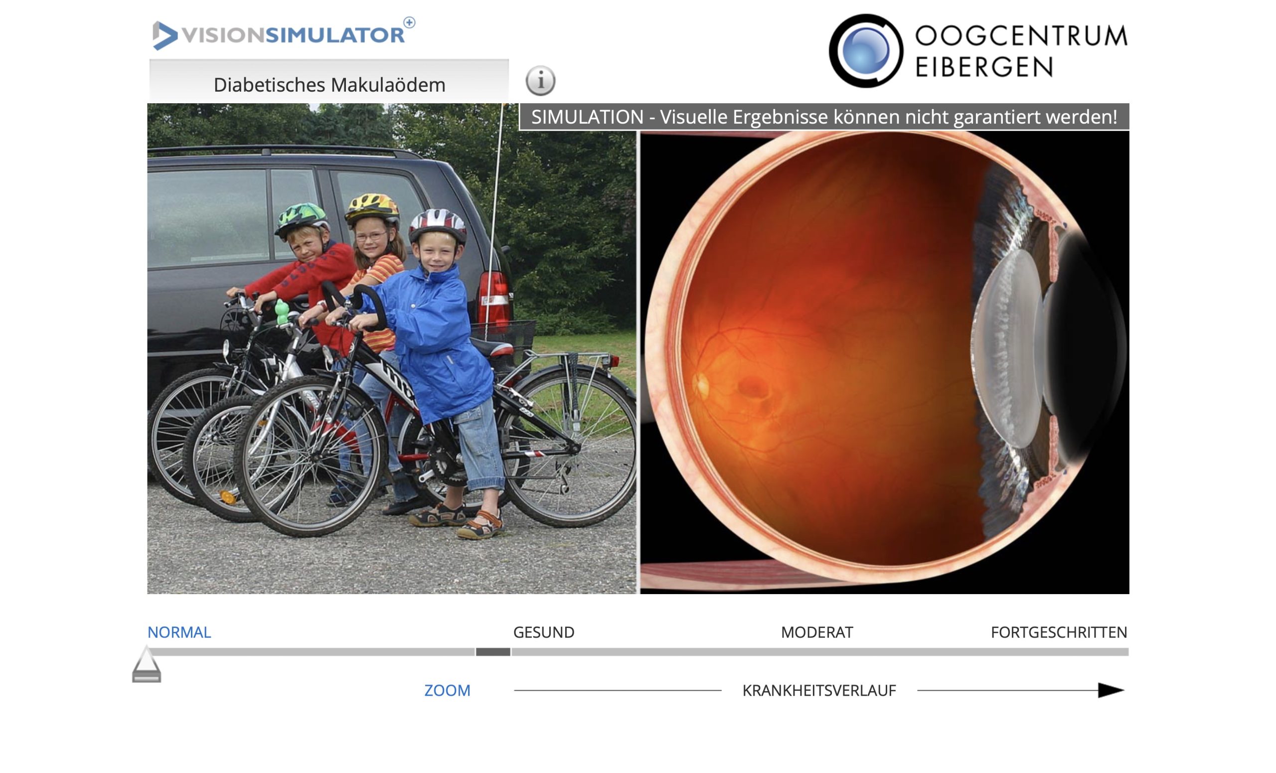 Diabetisches Makulaödem