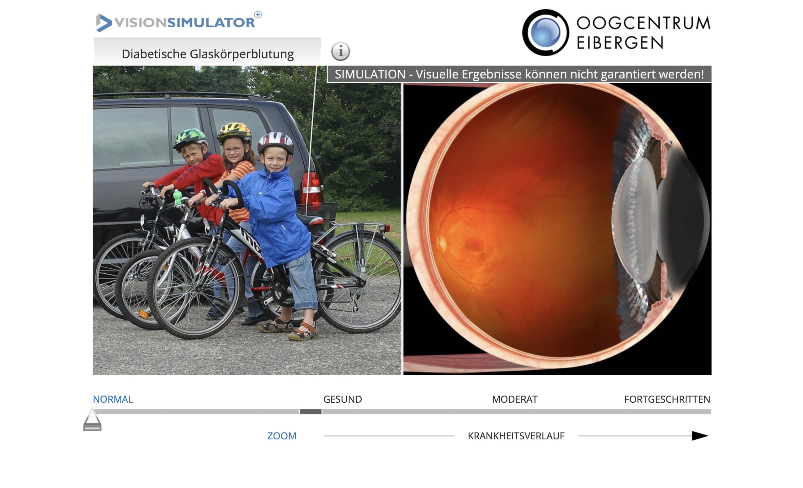 diabetische glaskörperblutung