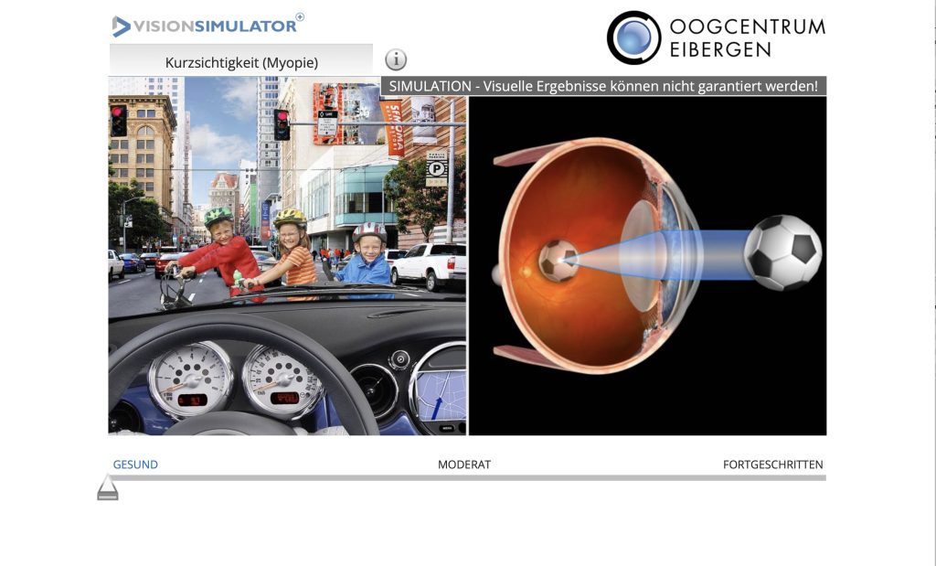 kurzsichtigkeit